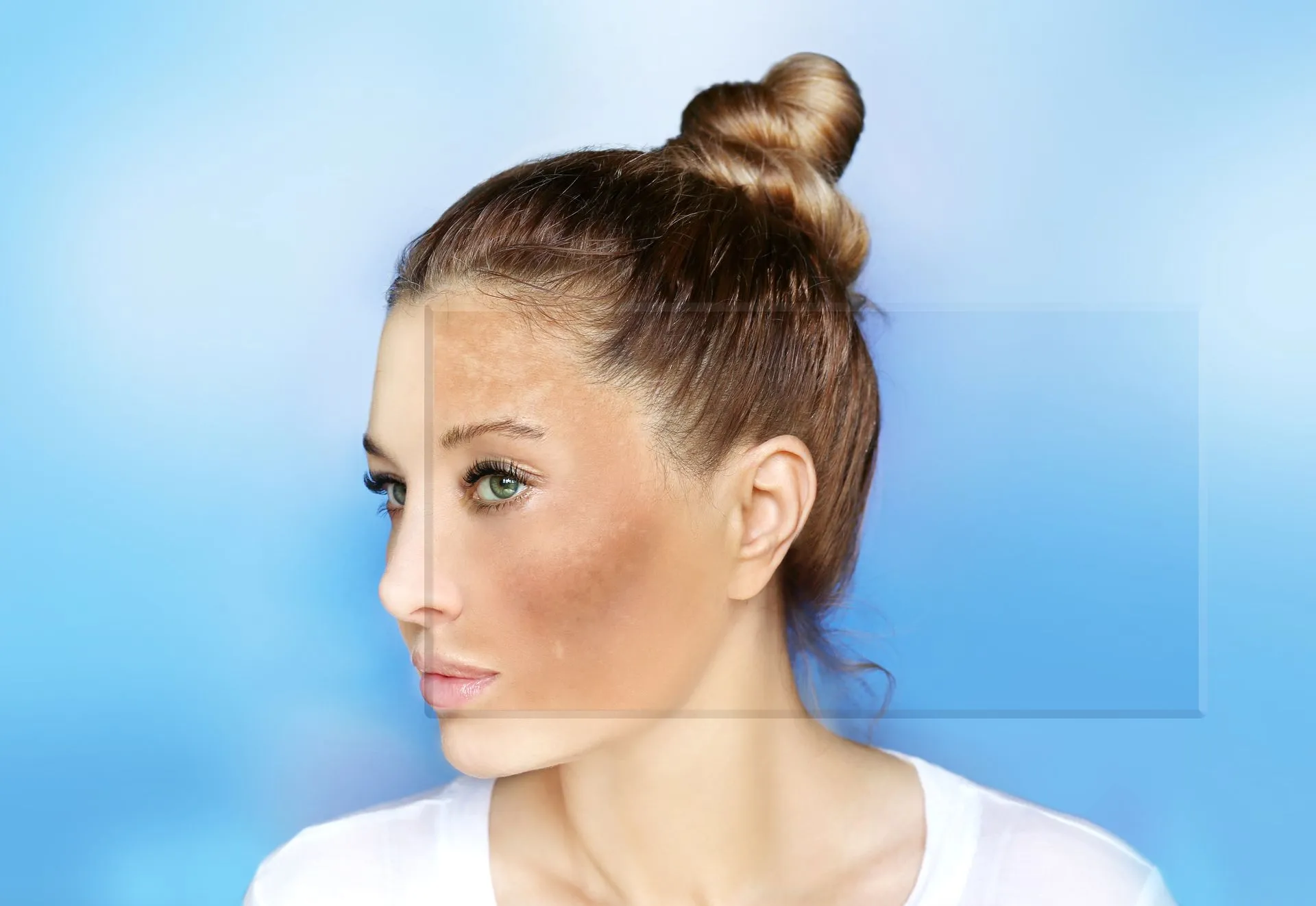 HYPERPIGMENTATION
Excessive production of melanin, leading to dark spots or patches on the skin
